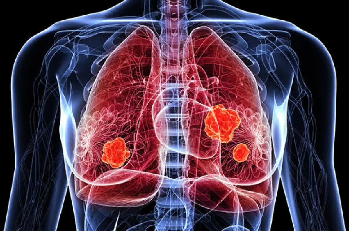 หยุดมะเร็งปอด! คร่า 41 ชีวิต/วัน  พบผู้ป่วยรายใหม่ 57 คน /วัน