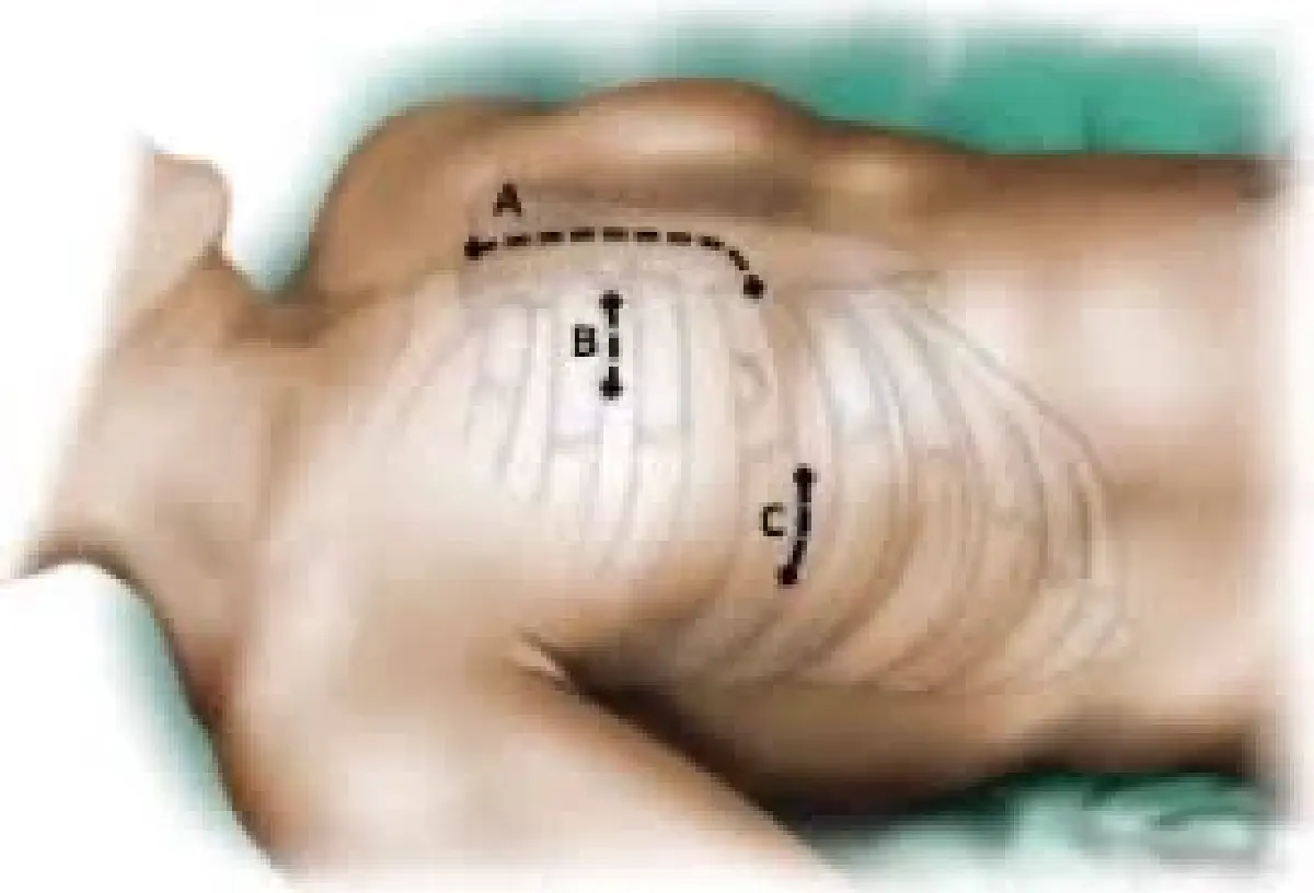 หัวใจฟื้นตัวไว! ผ่าตัดแผลเล็ก ทางเลือกใหม่ ลดภาระการรักษา