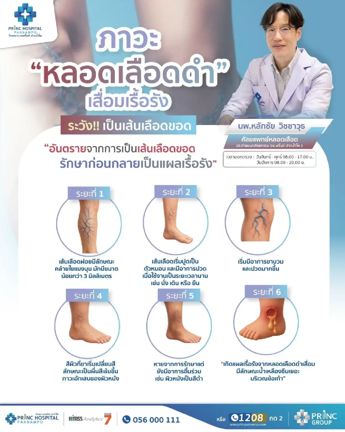 แพทย์ชี้ เส้นเลือดขอด ภัยเงียบแต่ร้ายแรง! เสี่ยงแผลเรื้อรัง-เสียขา ไม่รู้ตัว