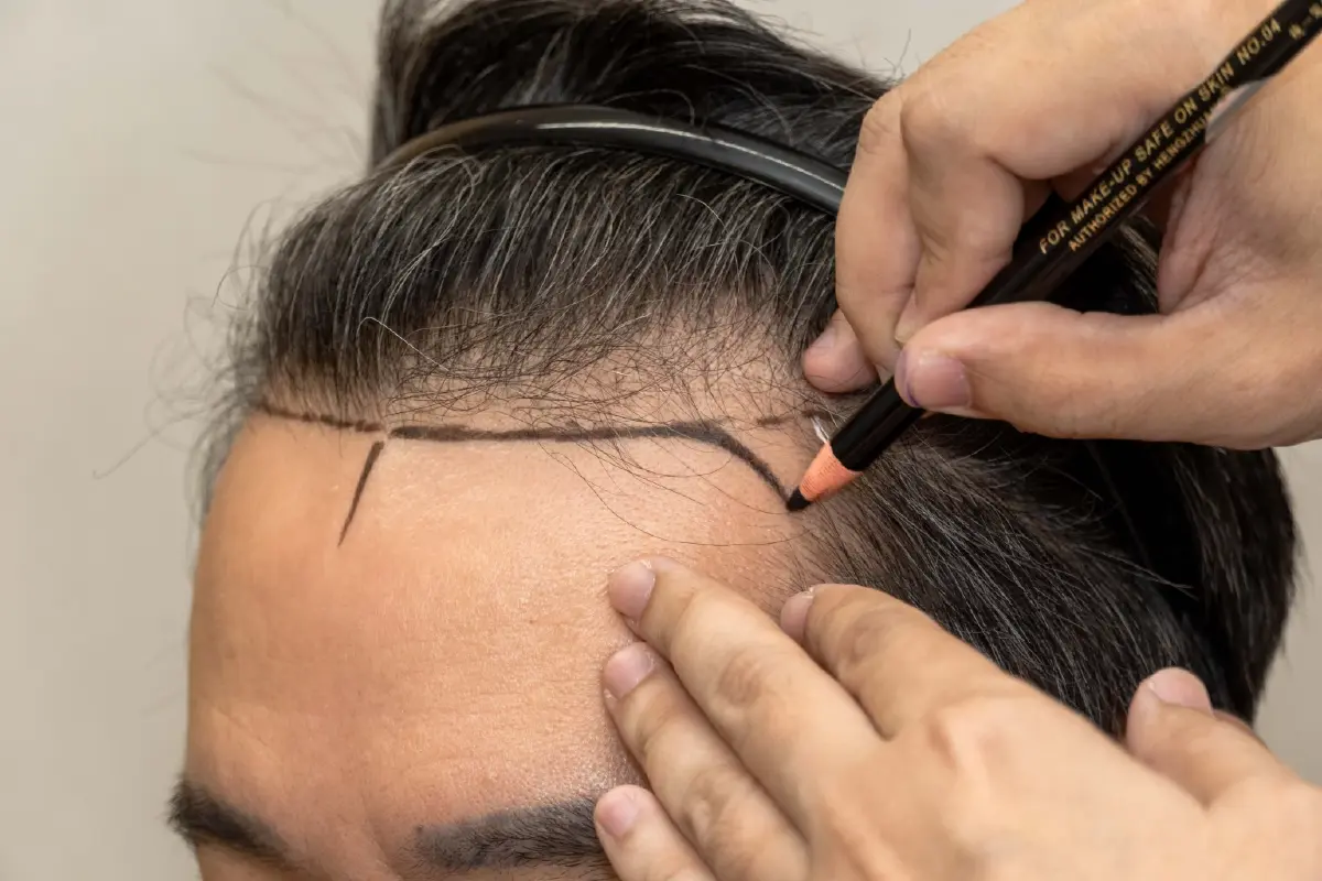 บอกลาผมร่วง-หัวล้าน! 'ศูนย์ปลูกถ่ายเส้นผม เมดพาร์ค' แก้ทุกโจทย์ปัญหา