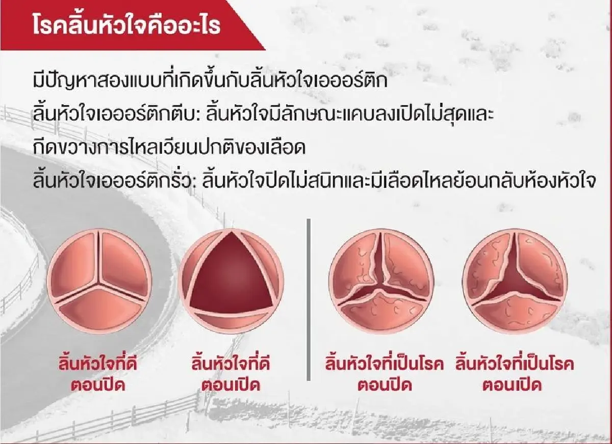 มิติใหม่ 'รักษาโรคลิ้นหัวใจ' ตลอดช่วงชีวิต เพื่อคุณภาพชีวิตที่ยั่งยืน