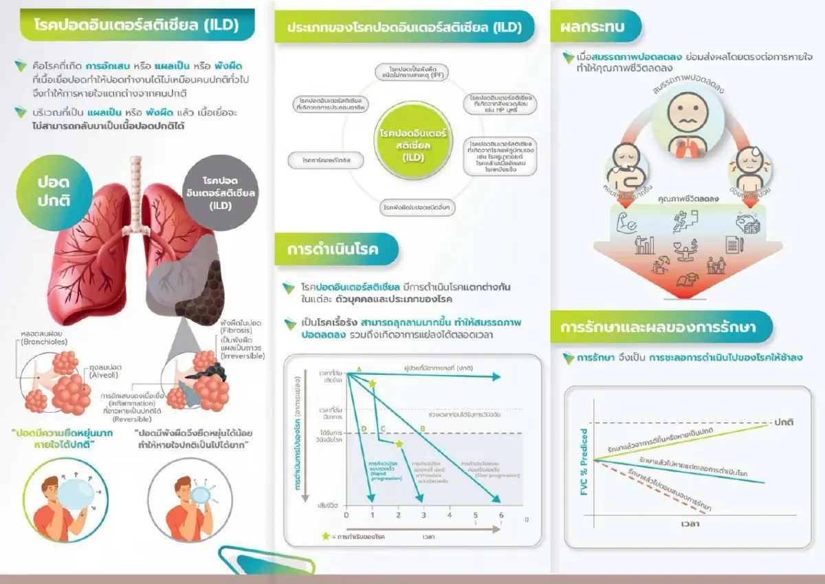 ‘HRCT Checklist’ ดิจิทัล ติดอาวุธรังสีแพทย์ – แพทย์ สู้ 'โรคไอแอลดี'
