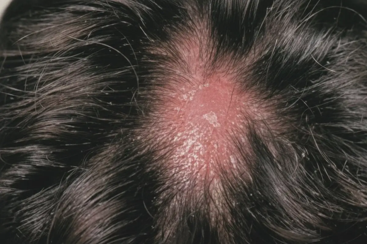 สวก. พัฒนายาสมุนไพรสะเก็ดเงินปรุงเฉพาะราย จ่อดันเข้าบัตรทอง