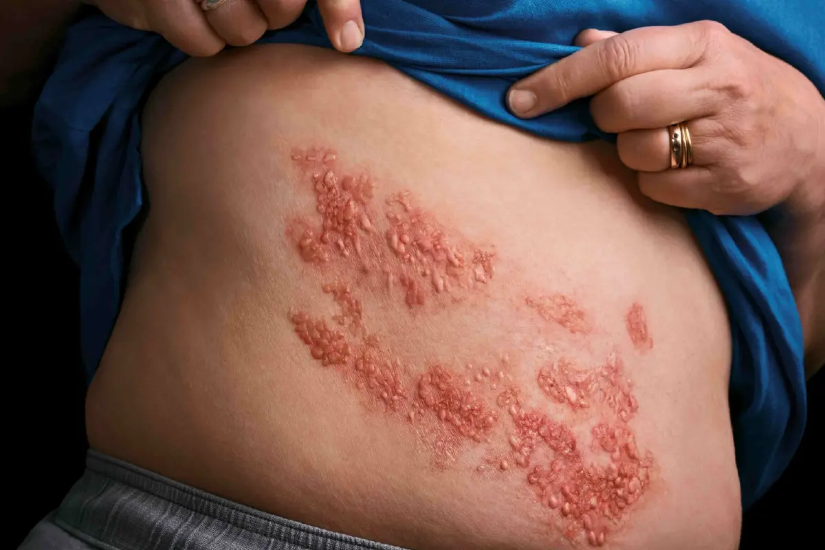 คนไทย 1ใน 3 เสี่ยงเป็นงูสวัด วัย 50+ กลุ่มโรคเรื้อรัง ระวังอาการทรุด