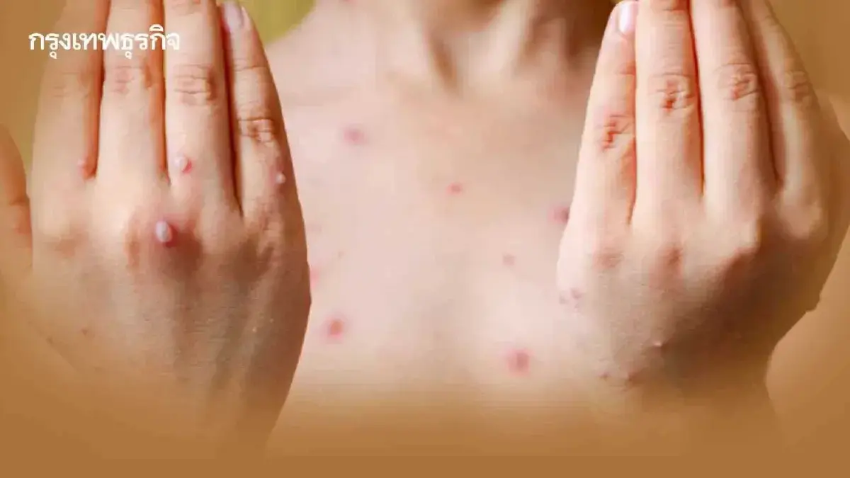 ด่วน! มธ.รังสิต สั่งปิดคณะหนี อีสุกอีใส ระบาดหนัก ให้เรียนออนไลน์