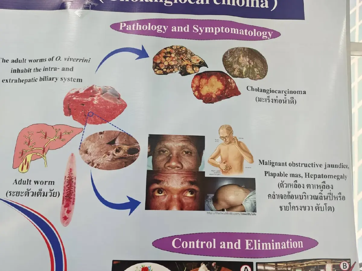 มข. พร้อมรับ WHO โชว์นวัตกรรมชุดตรวจ OV ATK แก้พยาธิใบไม้ตับ-มะเร็งท่อน้ำดี