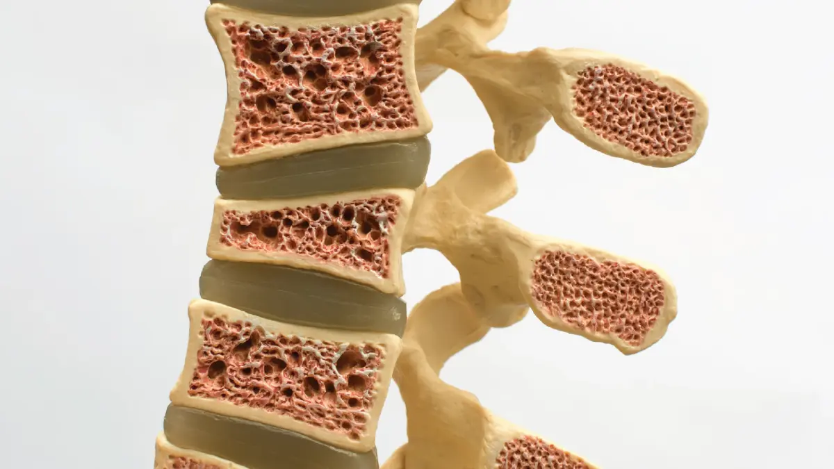 ไม่ล้มก็เสี่ยง! ความจริงกระดูกสันหลังยุบจากกระดูกพรุน ภัยเงียบสูงวัย