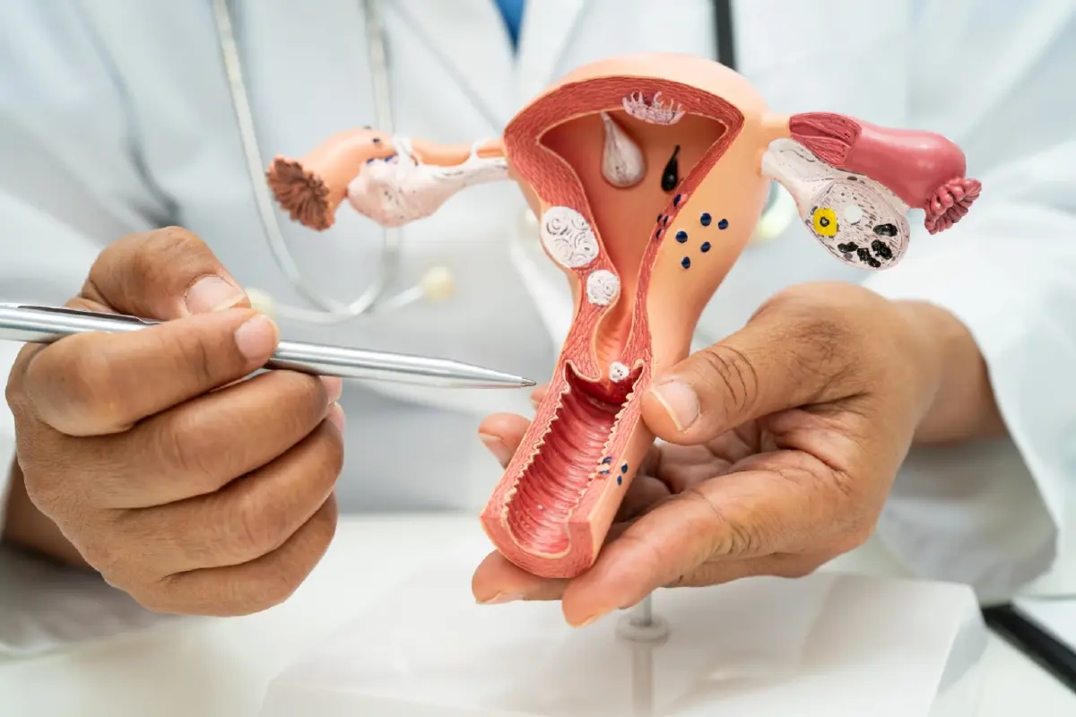 ปวดท้องเมนส์หนัก-มาเยอะผิดปกติ อย่าปล่อยผ่าน อาจเสี่ยง 'เนื้องอกมดลูก'