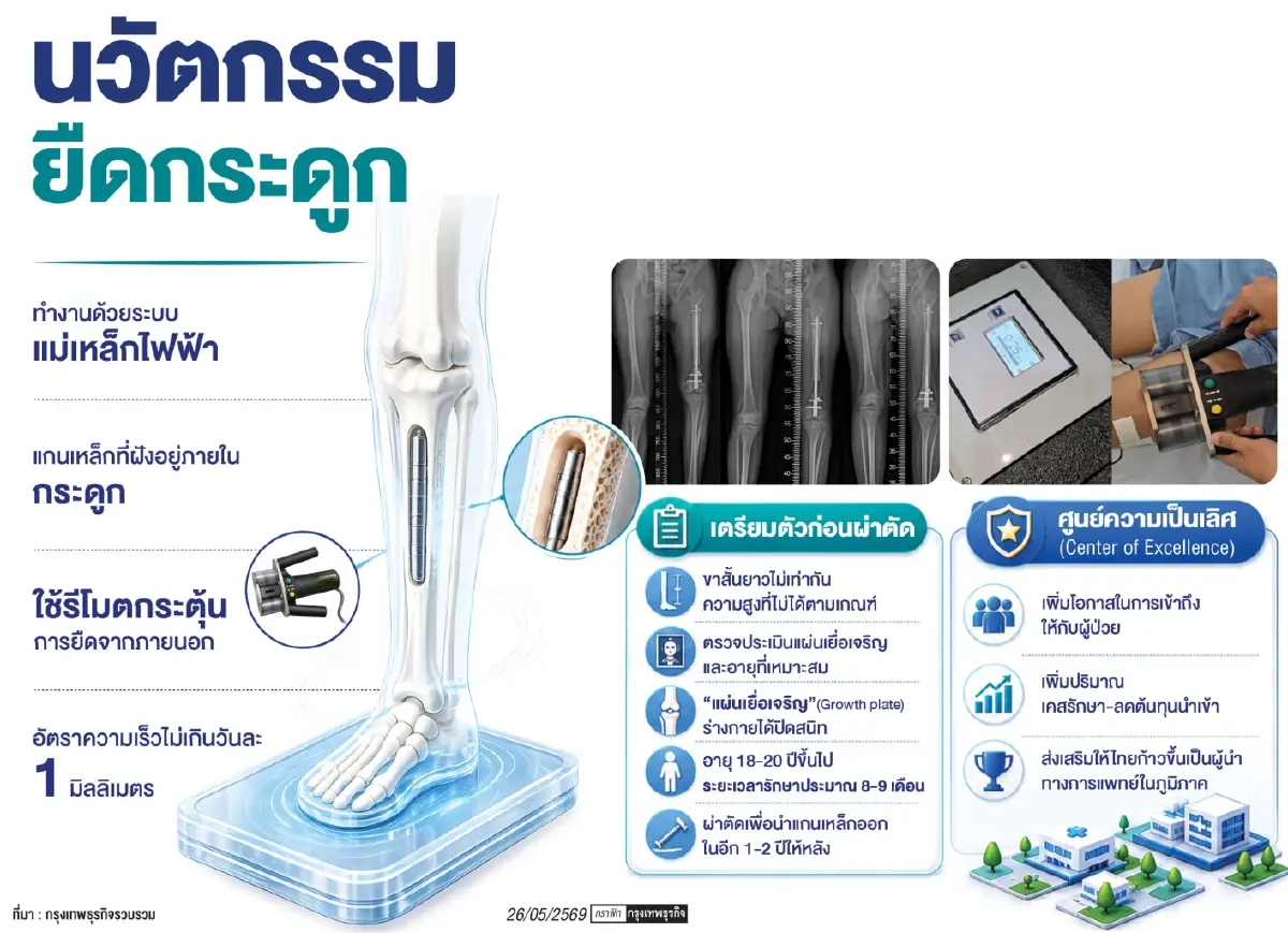 ผ่าตัด 'ยืดกระดูก' เพิ่มโอกาสการใช้ชีวิต  นวัตกรรมแก้เข่าโก่ง เข่าเก เพิ่มสูง