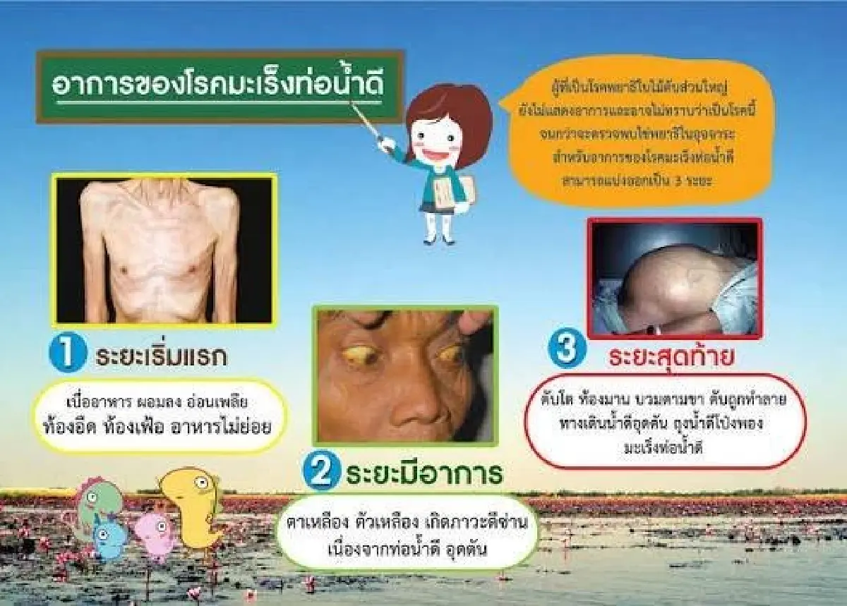 ทำไม 'วิกฤตหนัก' ศัลยแพทย์เฉพาะทางผ่าตัดมะเร็งท่อน้ำดี หมอโอดแฉหมด