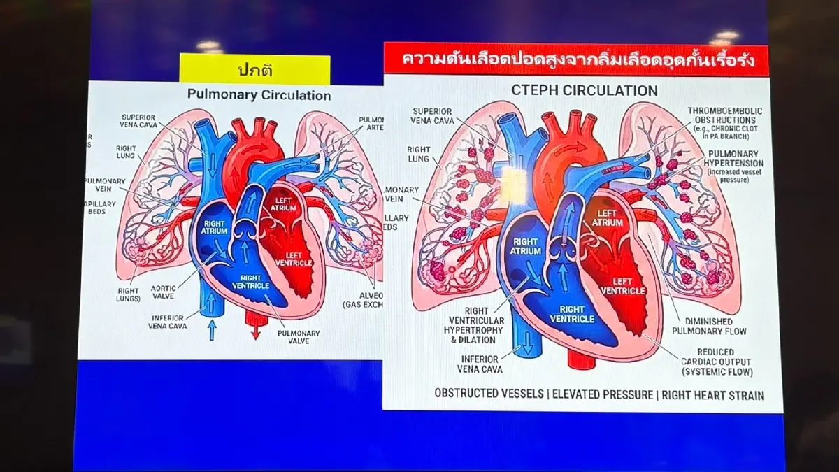 ศิริราช เปิดตัวนวัตกรรมรักษาลิ่มเลือดอุดกั้นปอดเรื้อรัง สำเร็จแล้ว 23 ราย