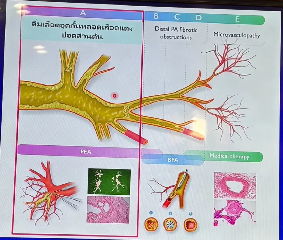 ศิริราช เปิดตัวนวัตกรรมรักษาลิ่มเลือดอุดกั้นปอดเรื้อรัง สำเร็จแล้ว 23 ราย
