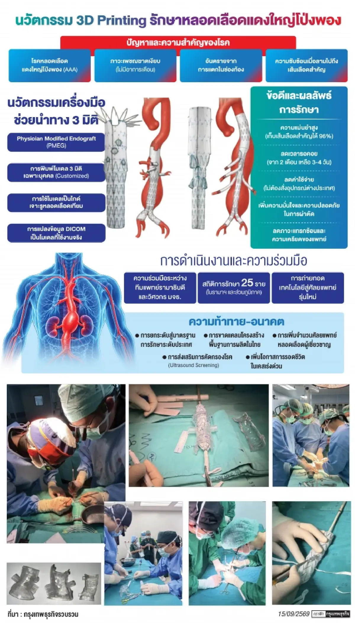นวัตกรรมกู้ชีวิต 'AI-3D Printing' เปลี่ยนการรอ ให้กลายเป็นโอกาสรอด