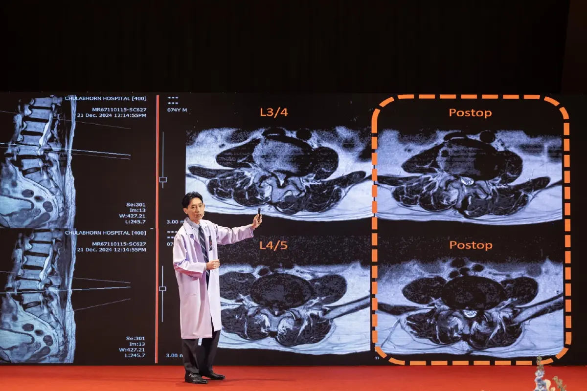รพ.จุฬาภรณ์ โชว์หุ่นยนต์ผ่าตัดกระดูกสันหลังชูธงงาน 'CRA MOVE FORWARD'