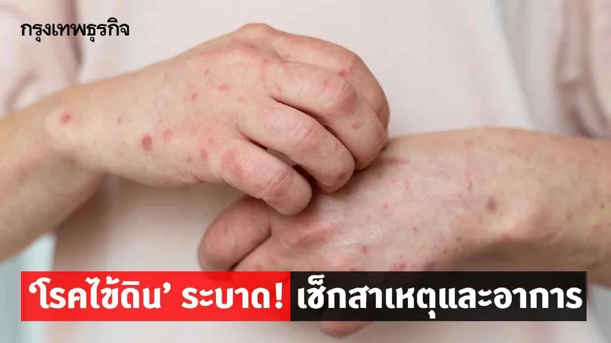 โรคไข้ดินล่าสุด ตาย 23 ป่วยสะสมทั่วประเทศ 732 เตือนชาวกรุงเช็กด่วน