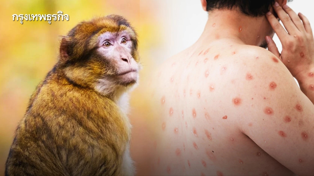'ฝีดาษวานร' รายใหม่ในไทย เกือบ 70 % ติดเอชไอวีร่วม