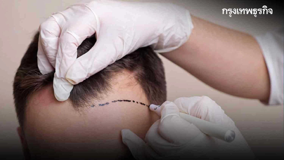 ‘ปลูกผมถาวร’ ความนิยมทั่วโลก ทางออก ‘ผมบาง ผมร่วง หัวล้าน’