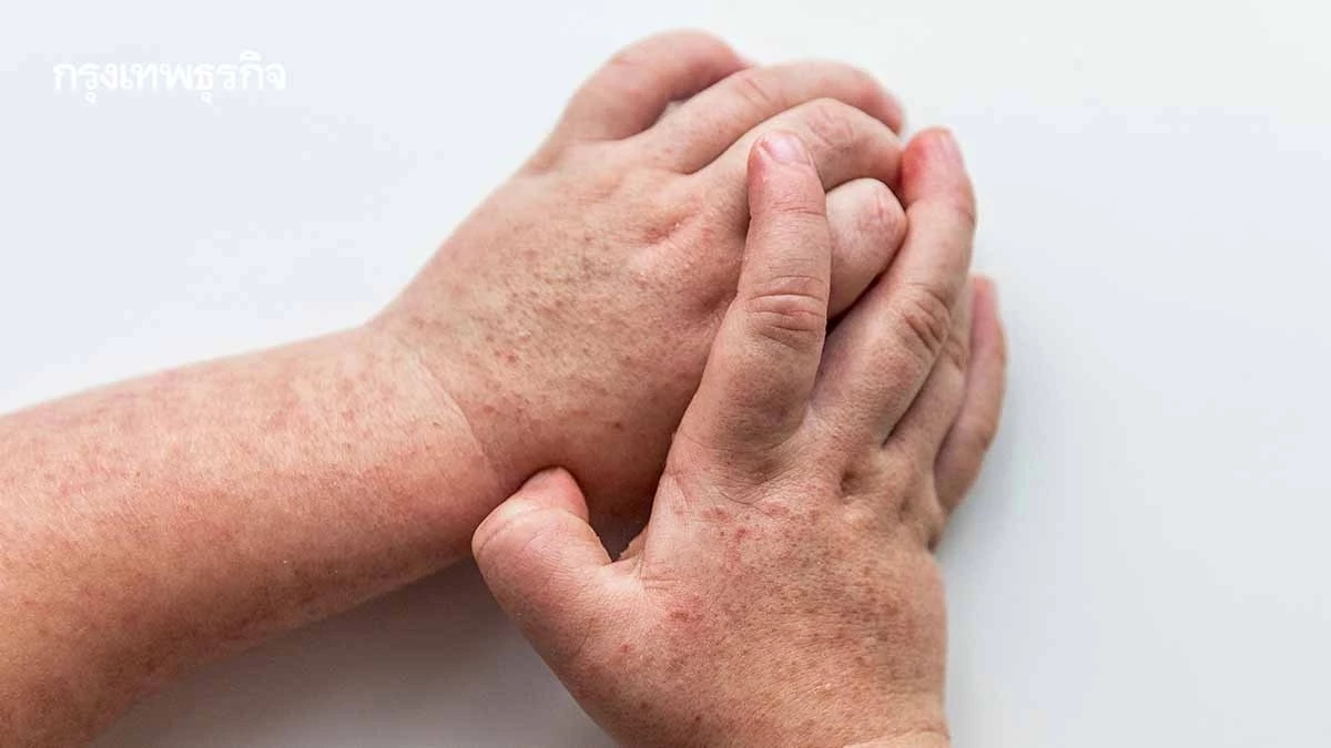 เช็กอาการ 'โรคไข้อีดำอีแดง' การแพร่ระบาด-ป้องกันทำได้อย่างไร