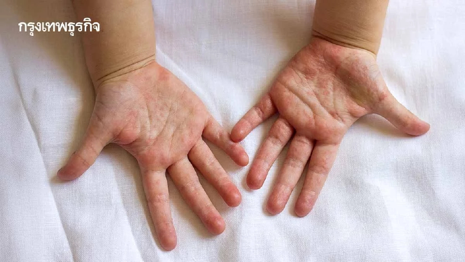 เตือน "ไข้อีดำอีแดง" ระบาด โรงเรียนย่านสมุทรปราการ ป่วยพุ่ง เช็กอาการของโรค