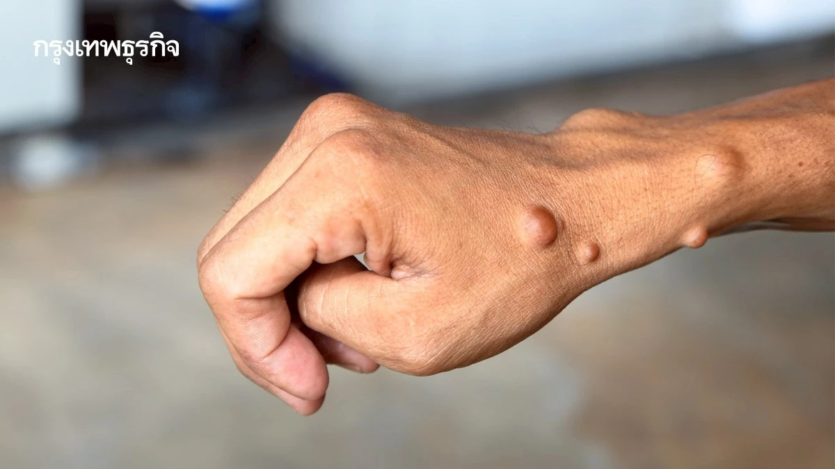 ตระหนักรู้ 'โรคท้าวแสนปม' อัตราการเกิดประมาณ 1 ใน 3,000 คน