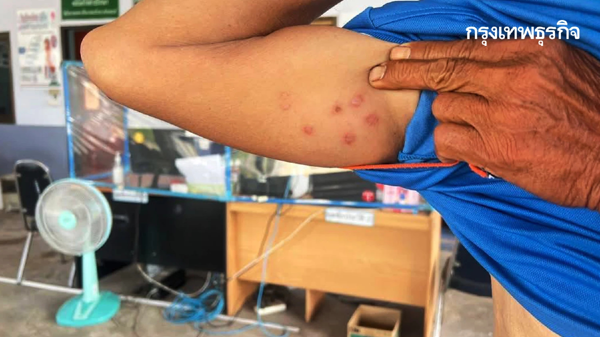 ผลตรวจออกแล้ว หนองบัวลำภู ไม่พบเชื้อแอนแทรกซ์ ในผู้ป่วยโนนสัง