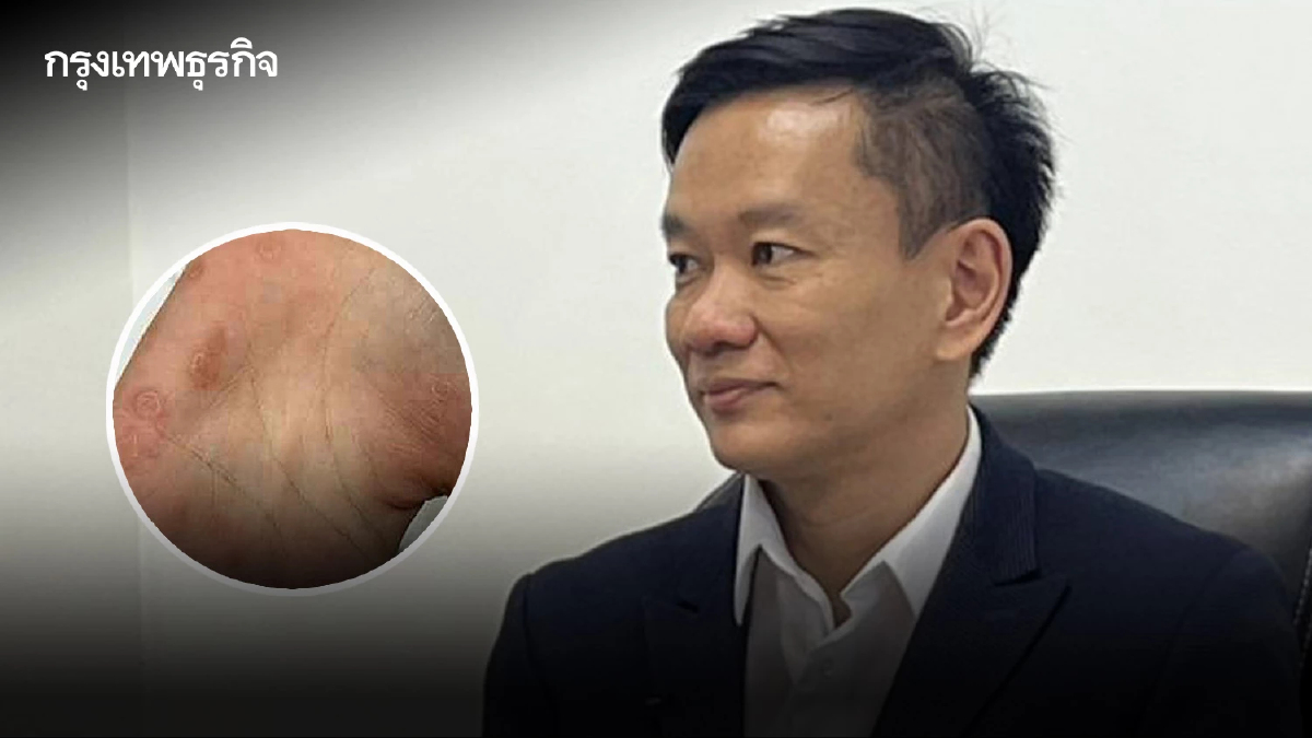 น่าห่วง! วัยรุ่นติดโรคทางเพศพุ่ง 13% - หลายรายติดเชื้อซิฟิลิสซ้ำ