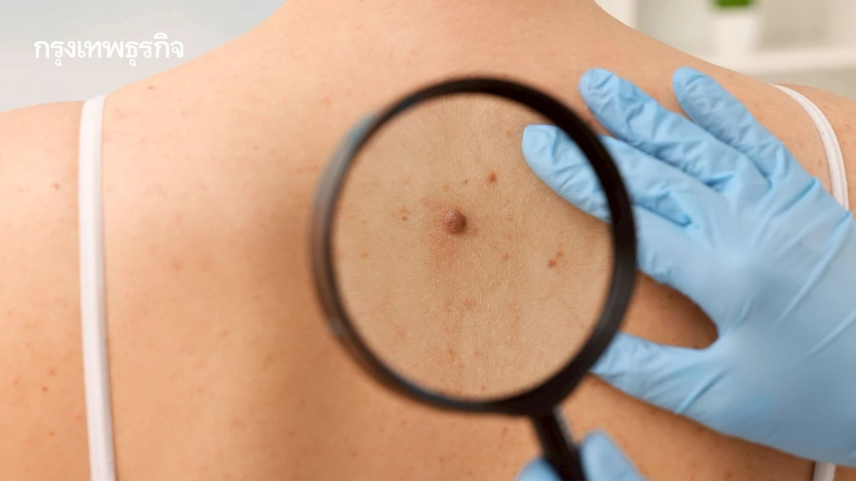ปัจจัยเสี่ยง-อาการ 'มะเร็งผิวหนัง' ที่พบได้บ่อย แนะประชาชน