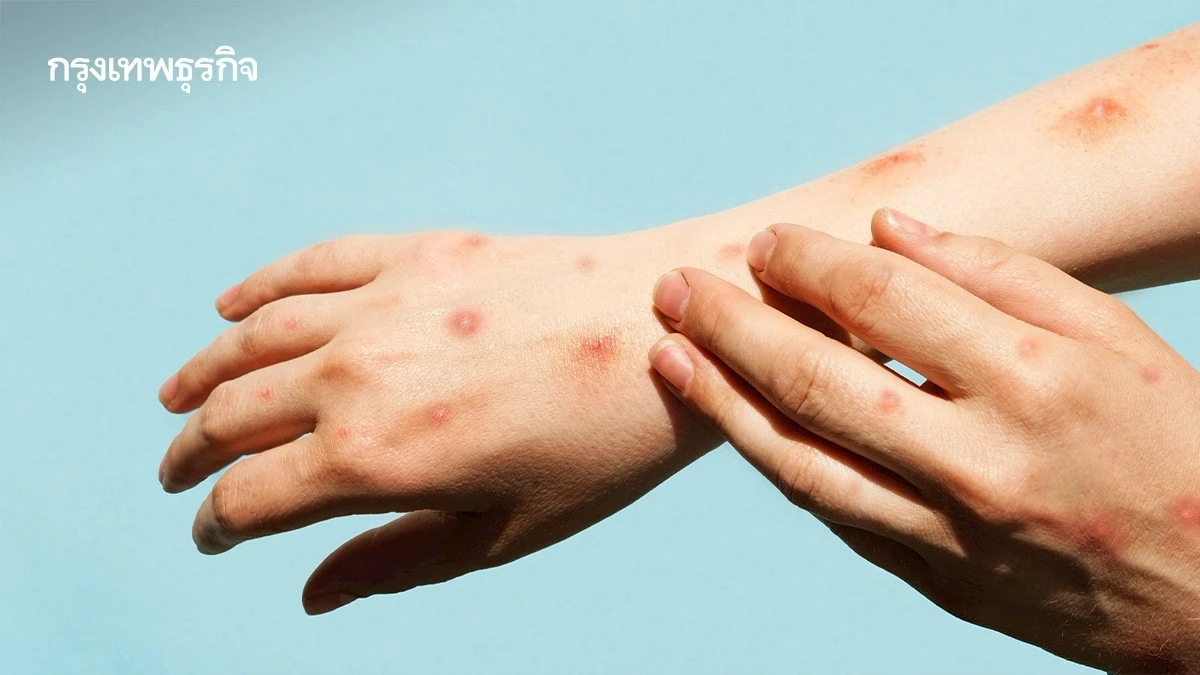 อย่ามองข้าม 'ไข้ดิน' ไม่ใช่แค่ไข้ธรรมดา พบผู้ป่วยแล้ว 147 ราย ดับ 5