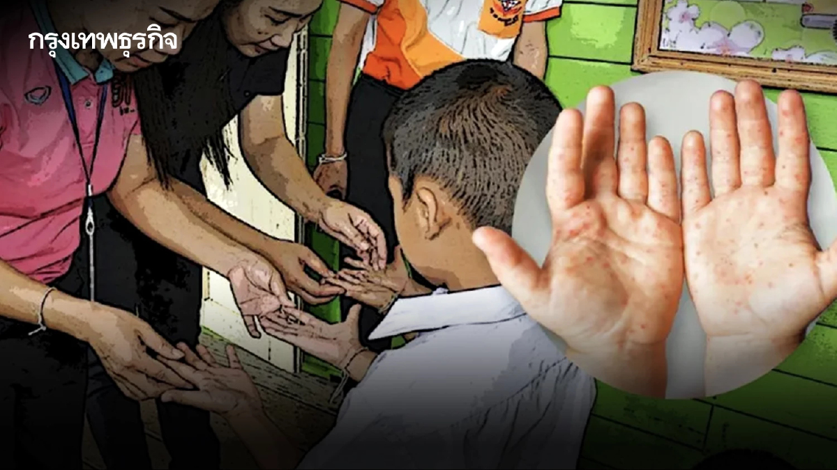 เตือน โรคมือเท้าปาก ระบาดหนักหน้าฝน เด็กป่วยแล้วกว่า 2.1 หมื่นราย