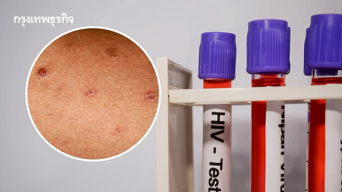 เปิดสถิติ ผู้ติดเชื้อ HIV-ซิฟิลิส พบอายุน้อยลง ปัจจัยเสี่ยงเพียบ