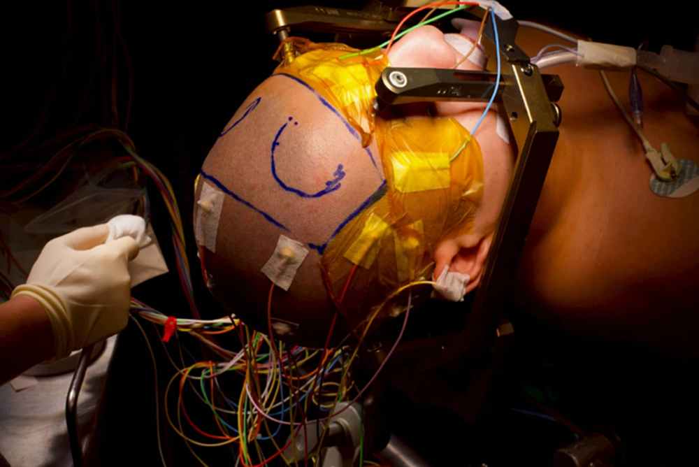 สถาบันประสาทวิทยา ผ่าตัดรักษา 'โรคทูเร็ตต์' สำเร็จเป็นรายแรก