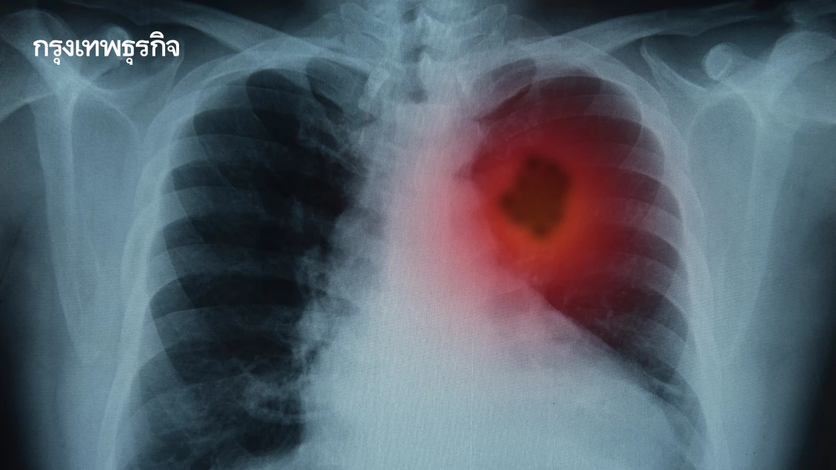 มะเร็งปอด PM2.5 ตัวปัญหา ไม่สูบบุหรี่ก็เป็นได้ เปิด 10 สัญญาณเตือน