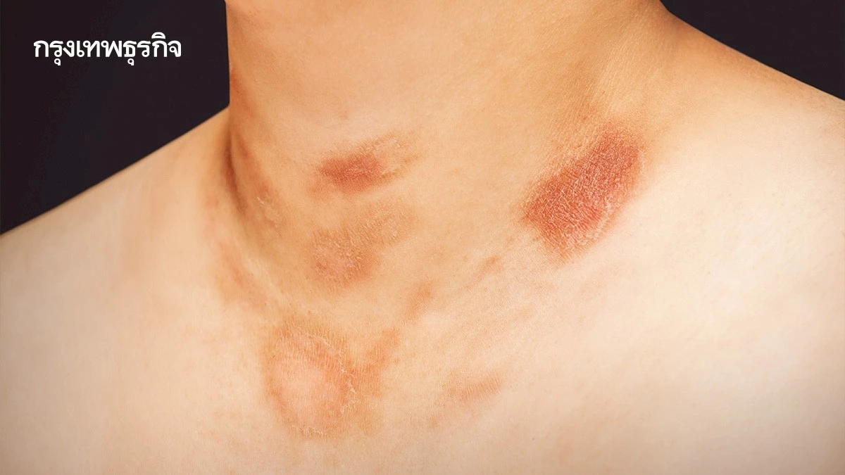 'โรคผื่นกุหลาบ' ไม่ใช่ผื่นคันธรรมดา เสี่ยงแท้งลูก คลอดก่อนกำหนด
