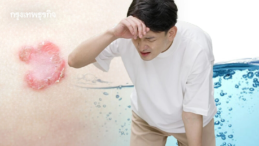ภัยสุขภาพ! เฝ้าระวัง 'โรคติดเชื้อ-ภาวะขาดน้ำ' ซ้ำเติมชาวบ้านชายแดน