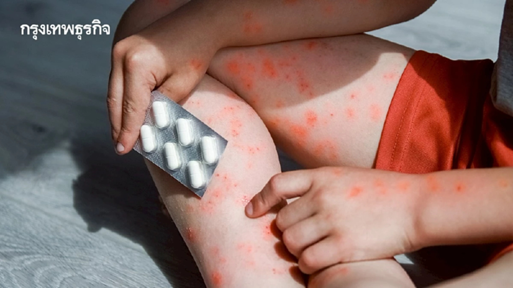'แพ้ยา' อันตรายถึงชีวิต เกิดขึ้นได้ทุกคน อาการแบบไหน? ต้องระวัง
