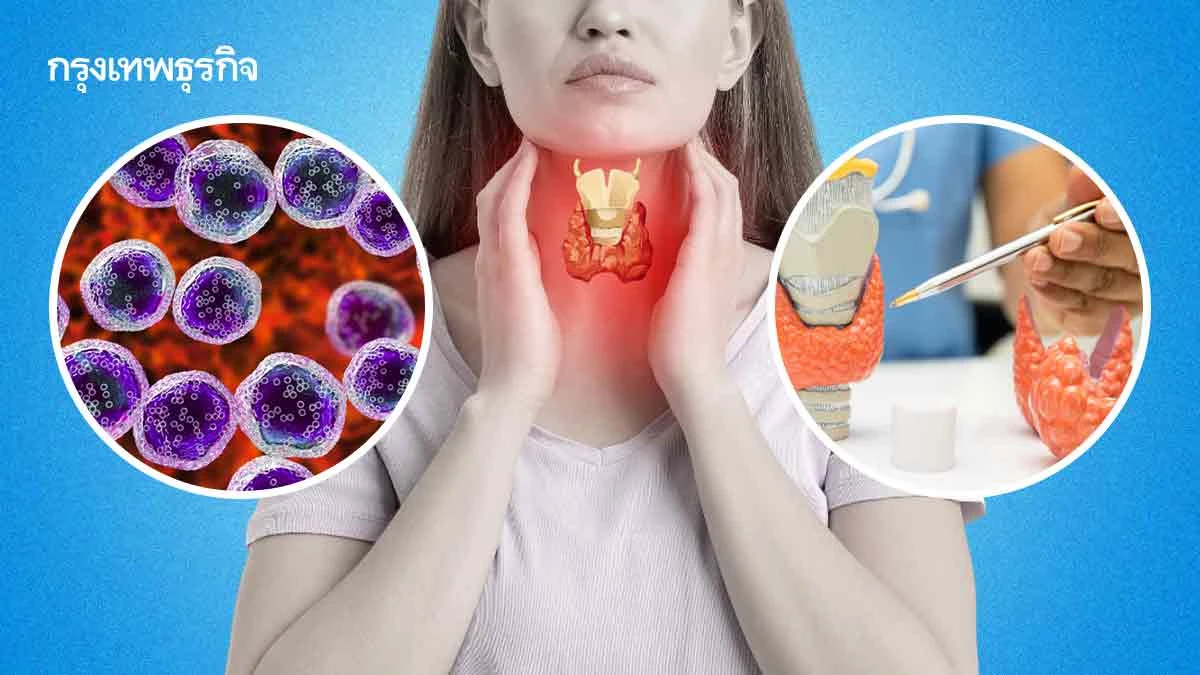 'มะเร็งต่อมน้ำเหลือง'พุ่ง ตรวจคัดกรองตั้งแต่เนิ่น ๆ รักษาหายได้