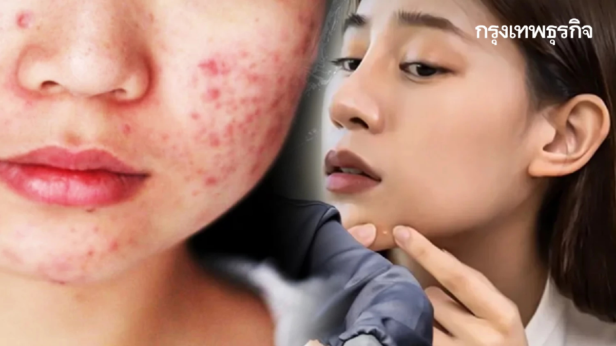 เป็นเรื่อง คนชอบกดสิว บีบสิวที่จมูก เสี่ยงสมองติดเชื้อ เสียชีวิต