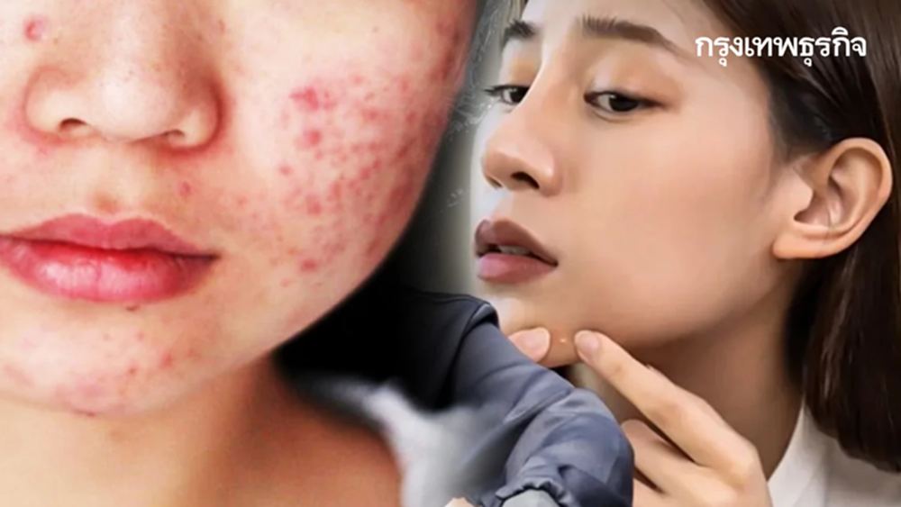 เป็นเรื่อง คนชอบกดสิว บีบสิวที่จมูก เสี่ยงสมองติดเชื้อ เสียชีวิต