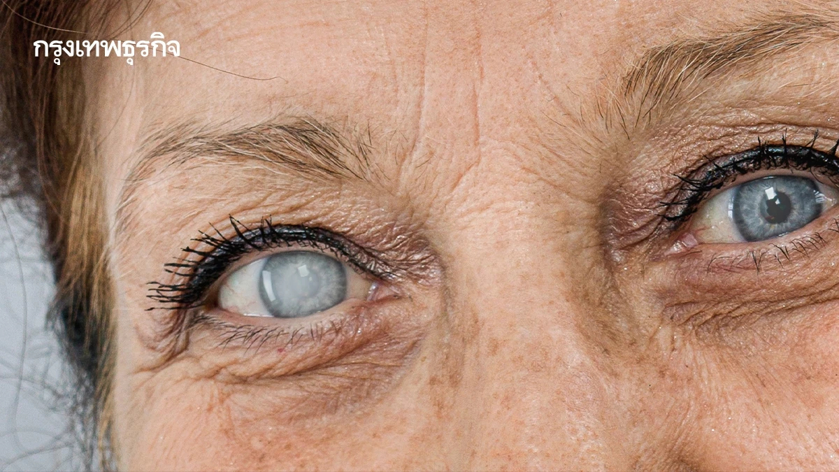 กรมการแพทย์ เผย '5 โรคตา' ที่พบบ่อย เป็นเมื่ออายุมากขึ้น