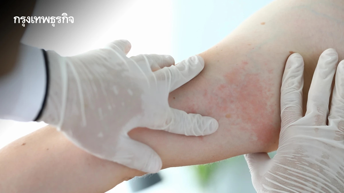 กรมควบคุมโรค เตือน 3 โรคนำโดยแมลง ป่วยกว่า 3 หมื่น -10 จังหวัดพบมาก