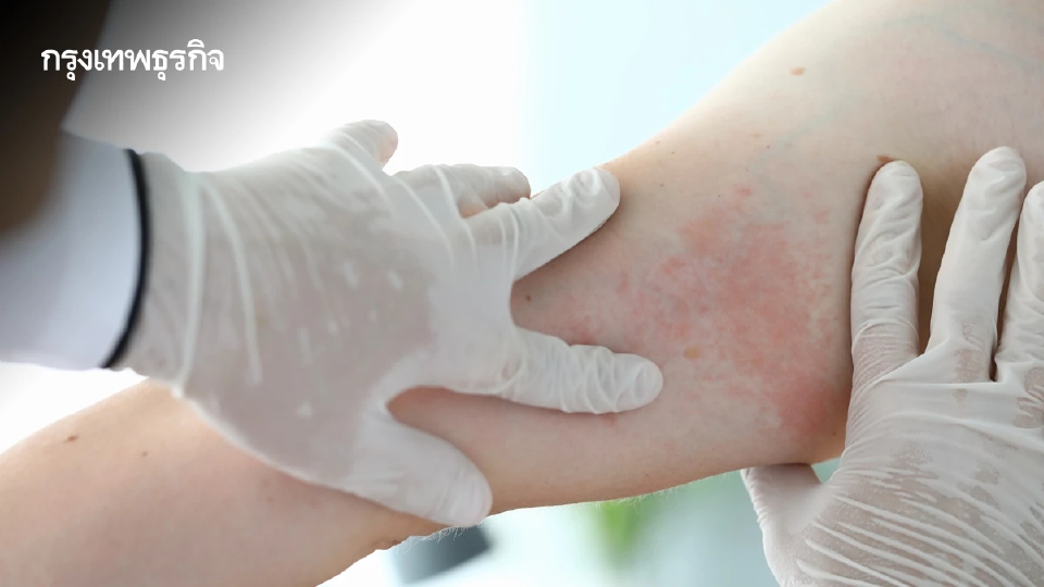 กรมควบคุมโรค เตือน 3 โรคนำโดยแมลง ป่วยกว่า 3 หมื่น -10 จังหวัดพบมาก