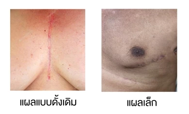 สถาบันโรคทรวงอกรักษา 'โรคลิ้นหัวใจ'แบบแผลเล็ก ไม่ตัดกระดูกกลางอก
