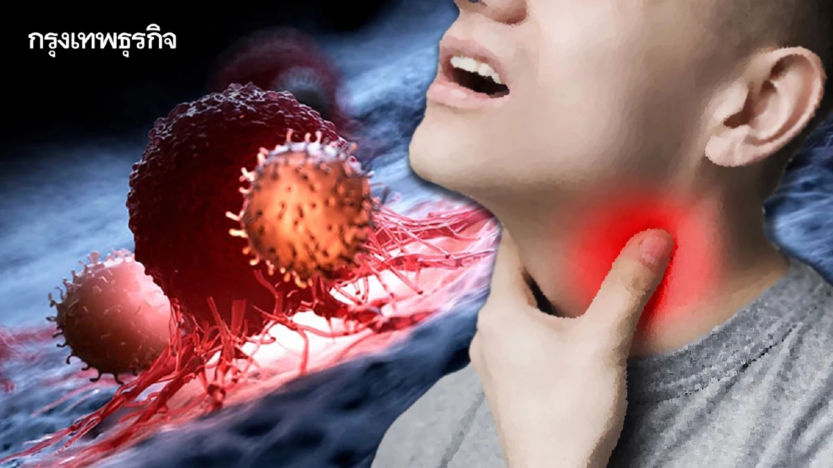 'มะเร็งต่อมน้ำเหลือง'แตะ 7,000 รายต่อปี 5 โรคมะเร็งพบมากสุดในเพศชาย