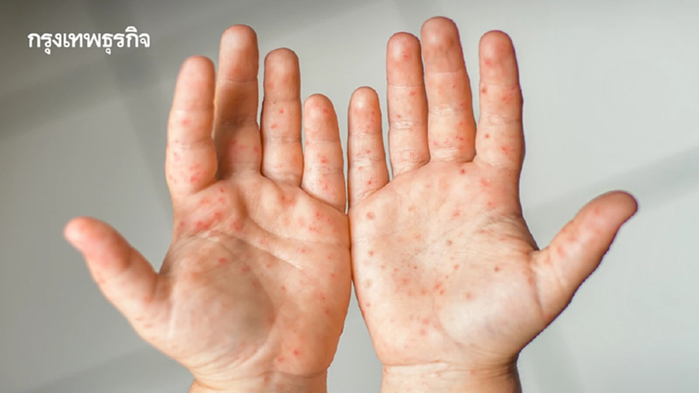 โรคมือเท้าปาก ระบาดหนักในเด็กเล็ก ยอดพุ่ง 1.7 เท่าจากปี 67
