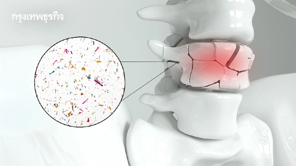 พบ ‘ไมโครพลาสติก’ ใน ‘กระดูก’ ทำกระดูกพรุนเปราะบางหักง่าย