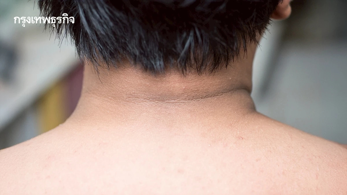 'คอคาร์บอน' เรื่องใกล้ตัวที่ไม่ใช่ขี้ไคล บ่งบอกโรคร้าย