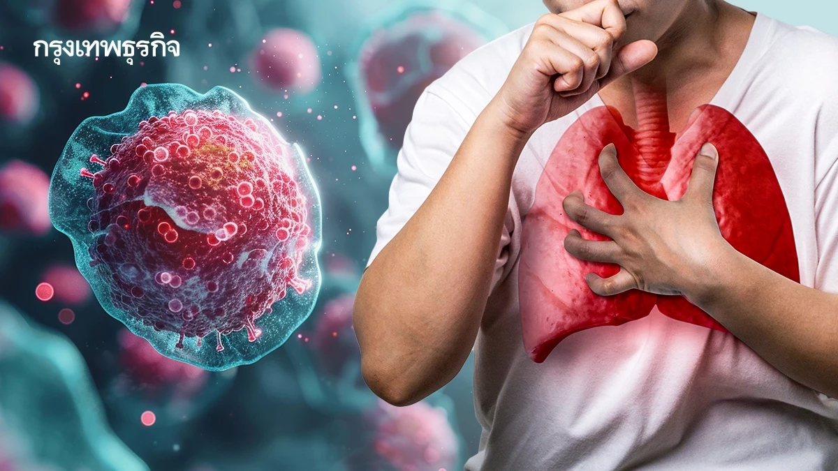 พบผู้ป่วยมะเร็งปอด ระยะลุกลาม 70% แนะตรวจคัดกรอง รู้เร็ว รักษาหาย