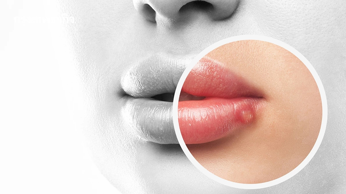 ‘เริม’ โรคกวนใจไม่อันตรายร้ายแรง แต่ เป็นแล้วไม่หายขาด