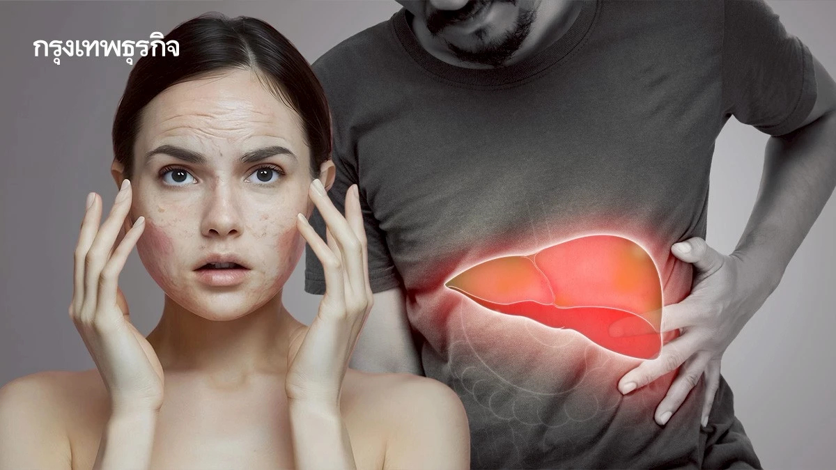 แพทย์เผย ‘ตับแข็ง’ เจอในคนอายุน้อยลงเรื่อยๆ ระยะแรกๆไม่มีอาการ