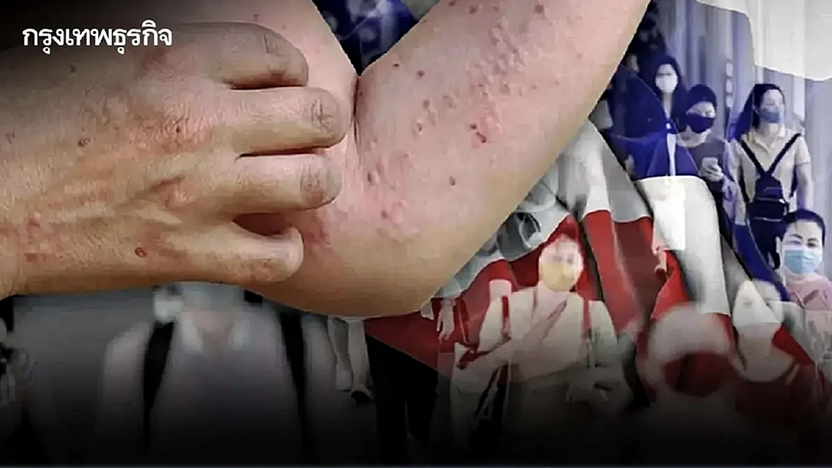 คร. เฝ้าระวัง 'โรคฝีดาษวานร' กทม. มีผู้ป่วยสูงสุด เป็นเพศชายถึง 97%